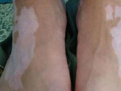 兰州中研医院效果好吗?如何有效治疗扩散中的白癜风？